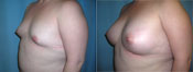 breast implant surger
