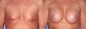 breast implant surger