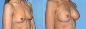 breast implant surger