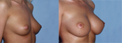 breast implant surger