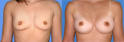 breast implant surger