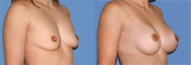 breast implant photos
