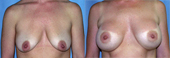 breast implant surger