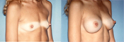 breast implant surger