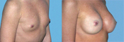 breast implant surger