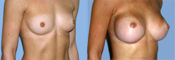 breast implant surger