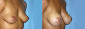 breast implant surger