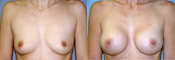 breast implant surger