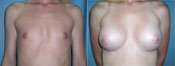 breast implant surger