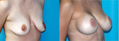 breast implant surger
