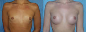breast implant surger