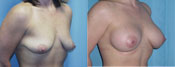 breast implant surger