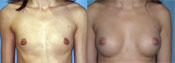 breast implant surger
