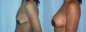 breast implant surger