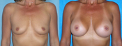 breast implant surger