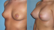 breast implant surger