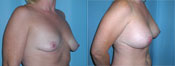 breast implant surger
