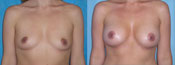 breast implant surger