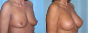 breast implant surger