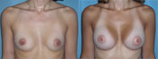 breast implant surger