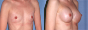 breast implant surger