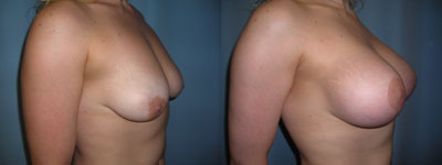 breast lift