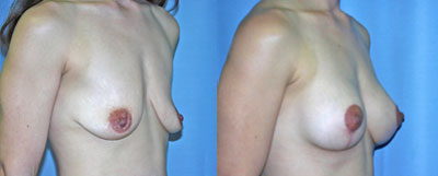 Breast Lift Surgery before and after photos