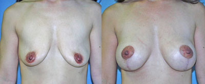 Breast Lift Surgery before and after photos