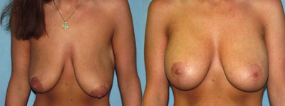 Breast Lift Surgery before and after photos