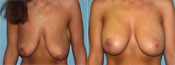 breast lift surgery photos