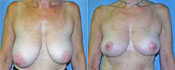 breast lift surgery photos