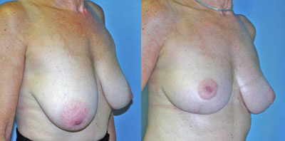 Breast Lift Surgery before and after photos