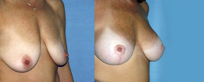 Breast lift photos
