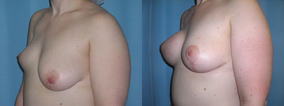 breast lift