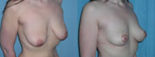 breast lift surgery photos