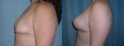 breast lift