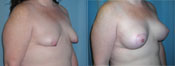 breast lift surgery photos