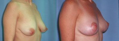 breast lift