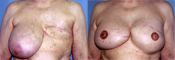 Breast Reconstruction Photos
