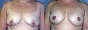 Breast Reconstruction Photos