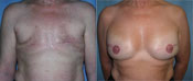 Breast Reconstruction Photos