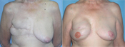Breast Reconstruction Photos