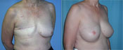Breast Reconstruction Photos