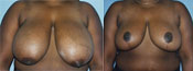 breast reduction surgery photos