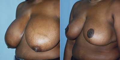 Breast Reduction surgery