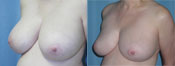 breast reduction surgery photos