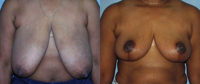 Breast Reduction surgery