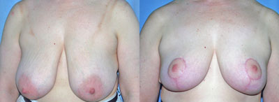Breast Reduction surgery