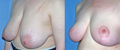 Breast Reduction surgery