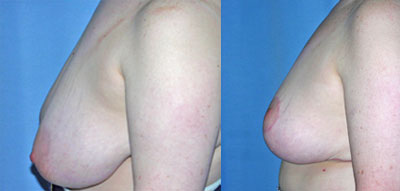 Breast Reduction surgery
